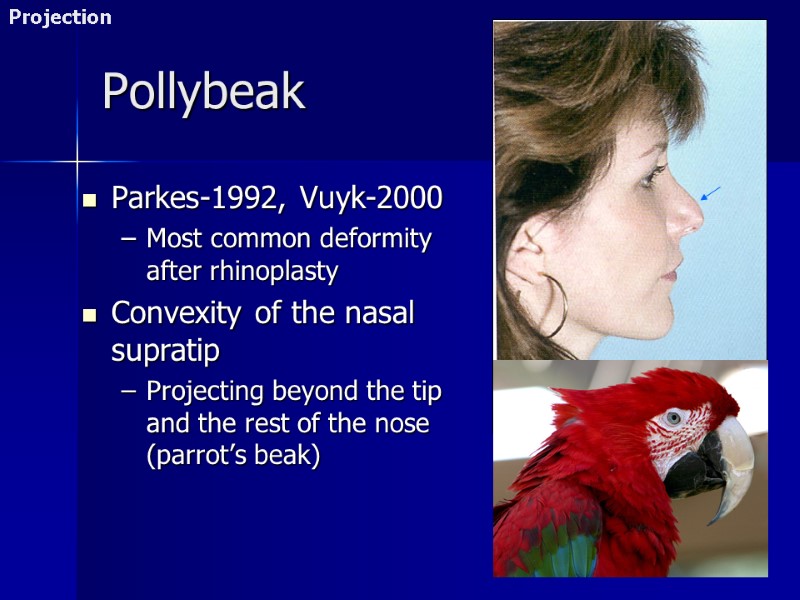 Pollybeak Parkes-1992, Vuyk-2000 Most common deformity after rhinoplasty Convexity of the nasal supratip Projecting
